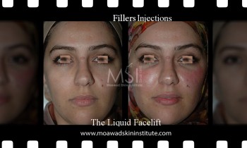 Face and Neck - Face Rejuvenation - Face lift - Before and After Photos Face and Neck - Face Rejuvenation - Face lift - Best cosmetic surgeon in Egypt - Cosmetic surgery