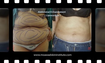 Abdominoplasty - Tummy tuck - Before and After Photos Abdominoplasty - Tummy tuck - Before and After Photos - Best cosmetic surgeon in egypt