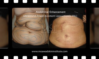 Abdominoplasty - Tummy tuck - Before and After Photos Abdominoplasty - Tummy tuck - Before and After Photos - Best cosmetic surgery in egypt