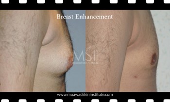 Gynecomastia Surgery - Male Breast Reduction - Best cosmetic surgeon in egypt Gynecomastia treatment (Male Breast Reduction)