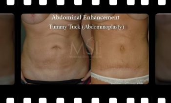 Abdomen Shaping (liposuction and or abdominoplasty) Abdomen Shaping (liposuction and or abdominoplasty) - Before and After Photos