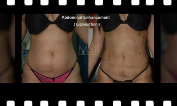 Abdomen Shaping (liposuction and or abdominoplasty) Abdominal Enhancement - Before and After Photos - Best cosmetic surgeon in cairo