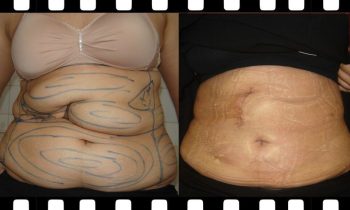 Abdomen Shaping (liposuction and or abdominoplasty) Abdominal Enhancement - Before and After Photos - Plastic surgery clinic