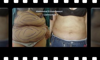 Abdomen Shaping (liposuction and or abdominoplasty) Abdominal Enhancement - Best cosmetic surgery in egypt