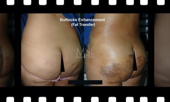 Brazilian Butt Lift (buttocks augmentation-fat injection) Brazilian Butt Lift (buttocks augmentation-fat injection) - Best cosmetic surgery in cairo