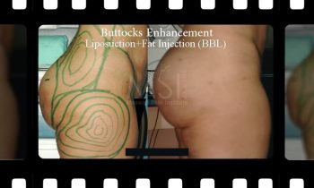 Brazilian Butt Lift (buttocks augmentation-fat injection) Brazilian Butt Lift (buttocks augmentation-fat injection)