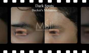 Dark Spots Laser Removal Dark Spots Laser Removal - Before and After Photos - Best cosmetic surgery in egypt