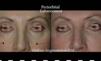 Eyes (periorbital) Fat Injection Eyes (periorbital) Fat Injection - Before and After Photos - Best cosmetic surgery in egypt