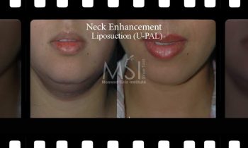 Neck Enhancement (U-PAL) Neck Enhancement - Before and After Photos - Best cosmetic surgeon in cairo