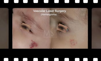Red Spots Laser Removal - Before and After Photos - Plastic surgery clinic Red Spots Laser Removal - Before and After Photos - Plastic surgery clinic